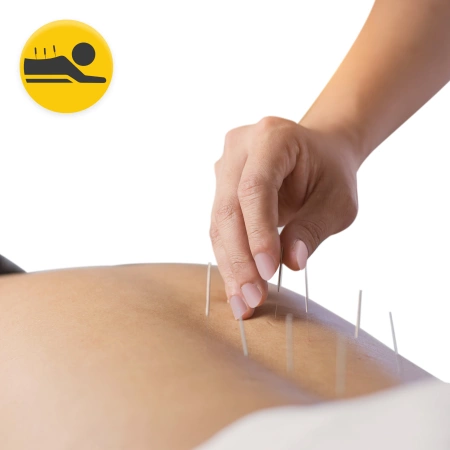 Ace de acupunctură cu ghid 100 buc. 0,25 x 25 mm