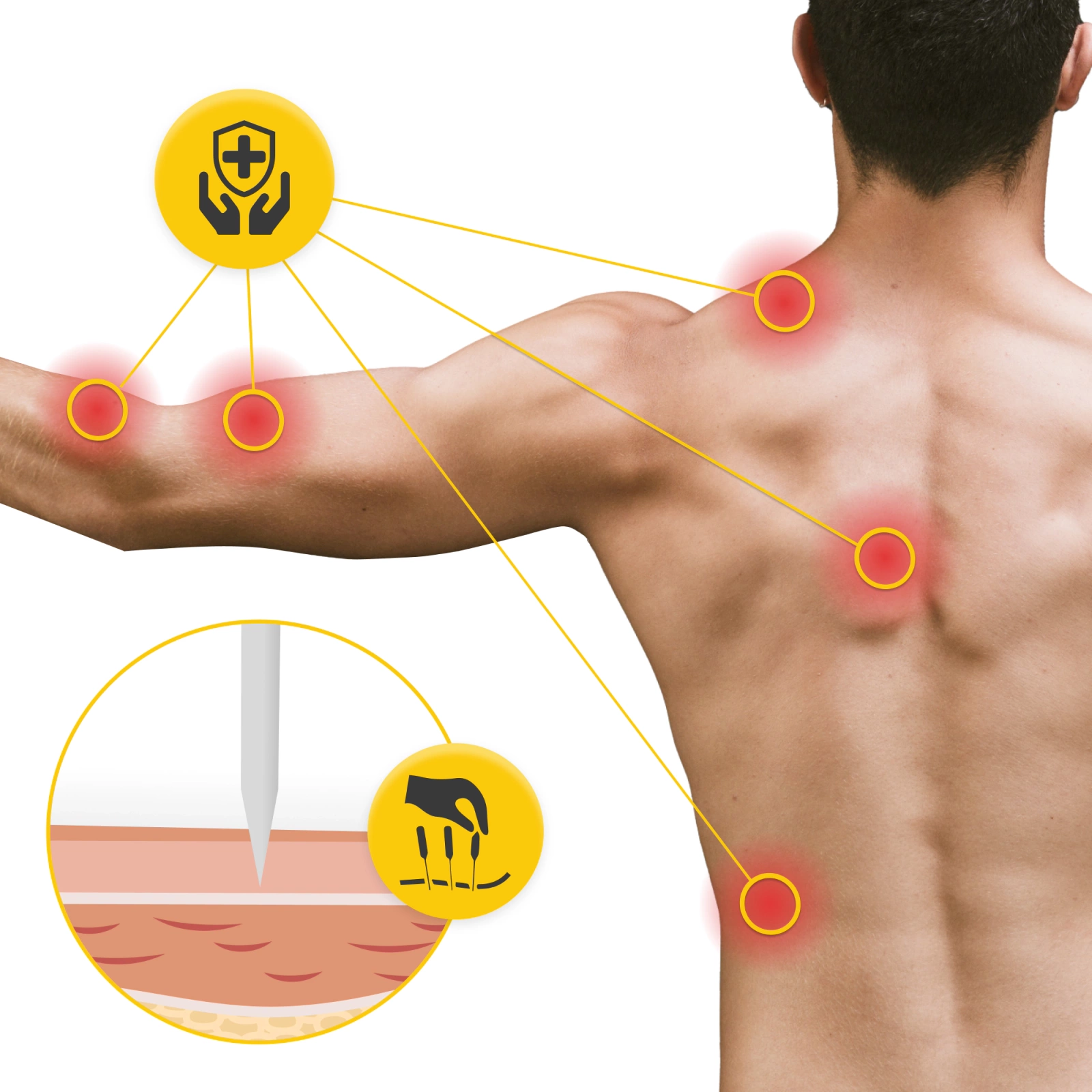 Ace de acupunctură cu ghid 100 buc. 0,25 x 15 mm